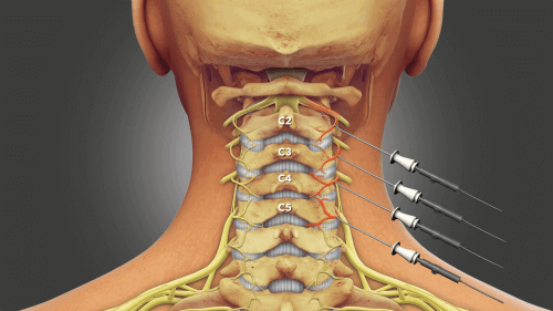 Illustration pointing out spinal discs C2-C5